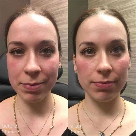 Cheek Filler - Illume Cosmetic Surgery & MedSpa