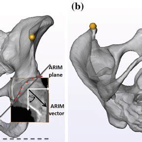 a Pelvic landmark point definitions. ASIS-L, ASIS-R: anterior –superior ...