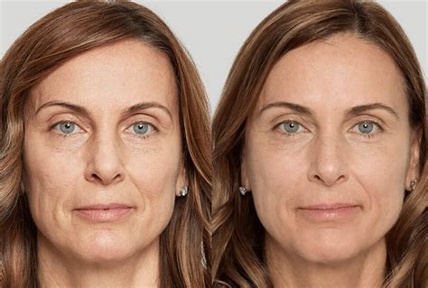 sculptra vancouver shine md