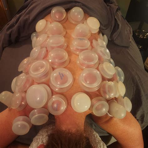 Knot an Issue cupping & Massage | Loveland CO