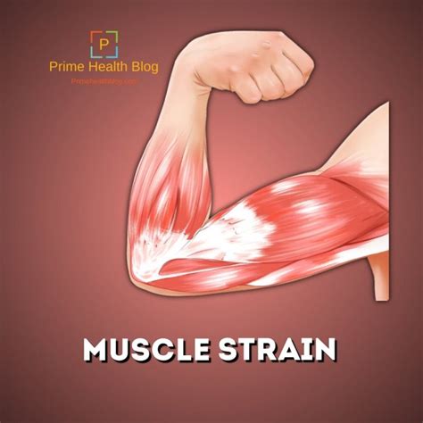 muscle strain   common   days prime health blog