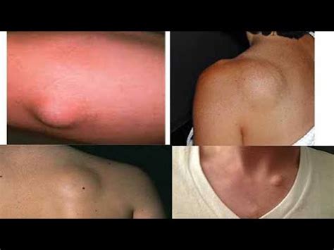 lipoma  telugu kenjutaku