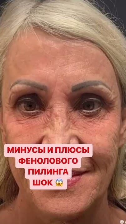 Глубокий феноловый пилинг.Химический пилинг.ЧИТАЙ НИЖЕ 👇 - YouTube