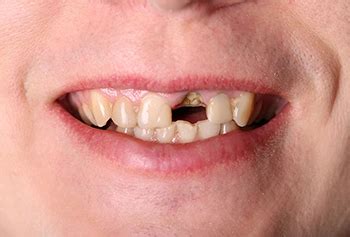 Loose Teeth - Causes, Treatment & Prevention