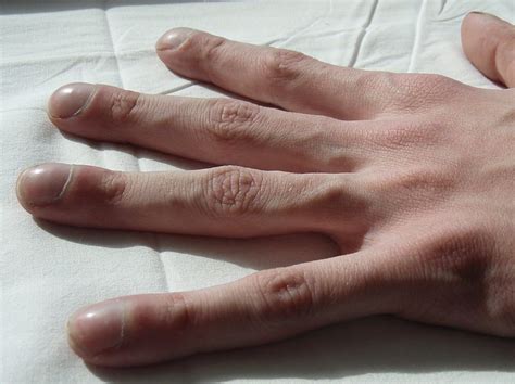 Cystická fibróza – Wikipedie