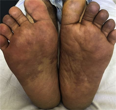 Why Are My Feet Hot At Night Hormones at Orville Turner blog