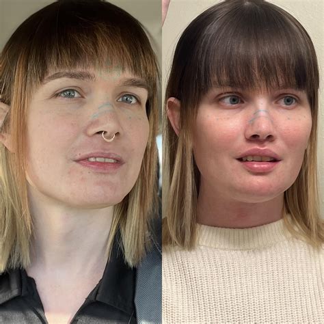 2285 best r/transgender_surgeries images on Pholder | 8 weeks post-op