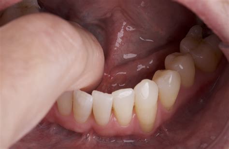 Self Oral Cancer Screening (SOCS) Education Program | School of