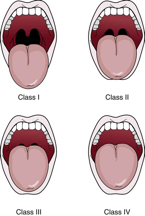 Mallampati Airway Score