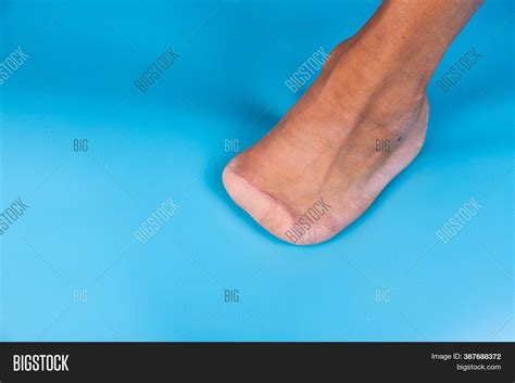 amputation  toes image photo  trial bigstock