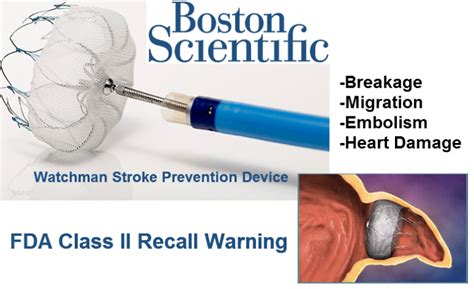 Watchman Stroke Device Lawsuit Claims & Settlements | Boston Scientific