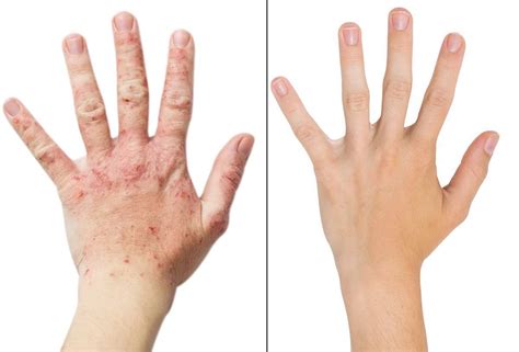ECZEMA? RED, SORE, ITCHY, DRY SKIN……LETS GET RID OF IT! 😊 - Hope ...