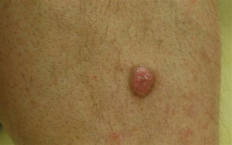 Hauttumor verirrte sich in die Mundhöhle | SpringerLink