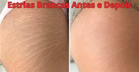 Tratamento Para Estrias Branca Antes E Depois