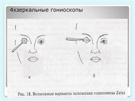 Гониоскопия - презентация онлайн