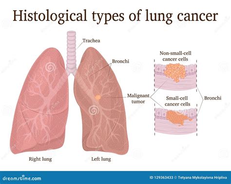 lung cancer cartoons illustrations vector stock images