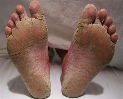 The Hard Facts About Foot Calluses - DermMedica
