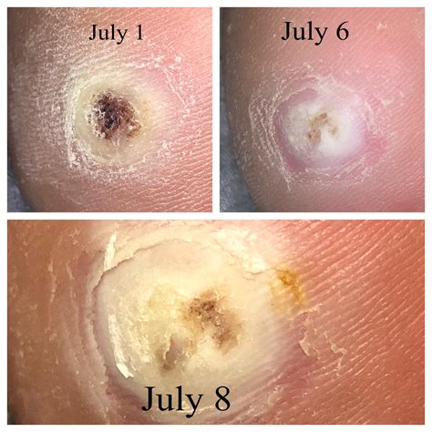 Progress on plantar wart, I feel like I’ve finally gotten past the hard
