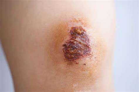 eschar stock  royalty  eschar images depositphotos