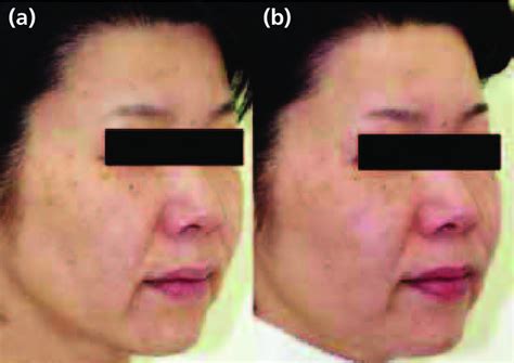 Case 8, disseminated solar lentigines on the face. (a) Before ...