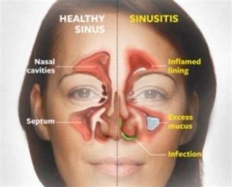 Natural Sinus Infection Home Remedy | HubPages