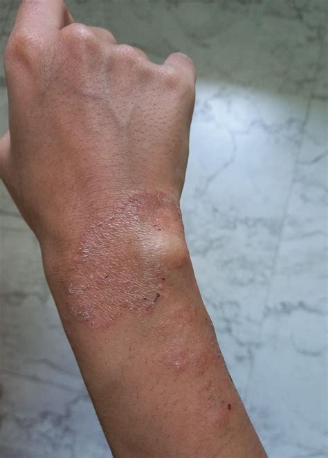 Recurring fungal infection on hand since 3 years : r/DermatologyQuestions