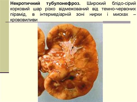 Хвороби нирок - презентация онлайн