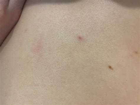 Is scabies gone or not? Picture of post-treatment black dot pimple ...