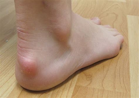 Haglund's Deformity - Farnsworth Orthopedic Physical Therapy