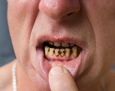 Meth Mouth: How Methamphetamine Use Affects Dental Health