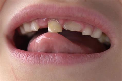 Loose Teeth Causes & Treatments | Essenmacher Family Dental