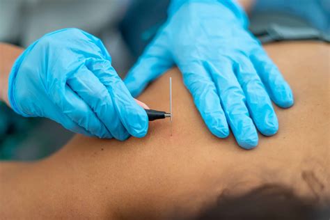 What is Dry Needling? Trigger Point Dry Needling in Austin, TX - FRWD