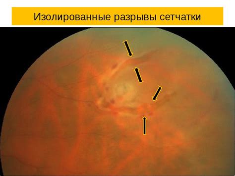 Отслойка сетчатки