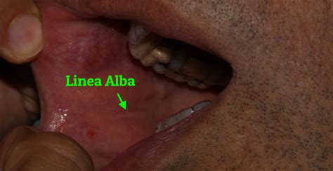 Linea Alba - Brisbane City Dentist