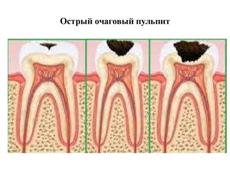 Пульпит временных и постоянных зубов у детей - презентация онлайн