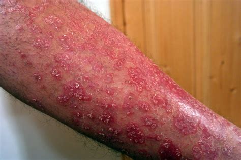 psoriasis    pictures  symptoms treatment