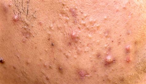 Acne Papules: vs. Pustules & Symptoms, Causes & Treatment