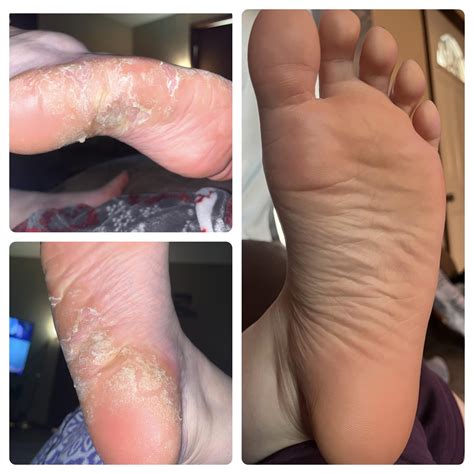 Dupixent results. It has completely cleared my skin. : r/eczema