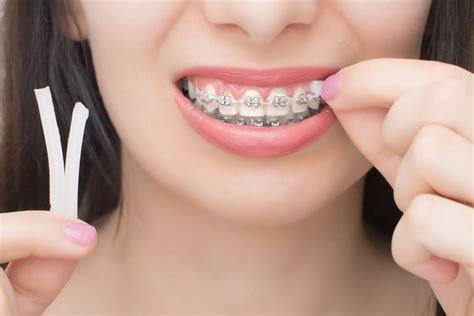 Benefits of Dental Wax for Braces & How To Use It