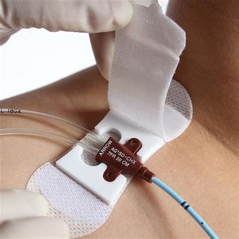 peranti penetapan kateter china hemodialisis kateter picc cvc kateter