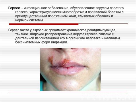 Генитальный Герпес Презентация - metricscatalog