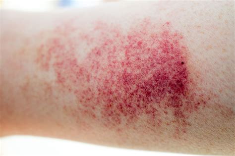 Fungo No Microscópio - Fungo na pele: O que é, sintomas e como tratar corretamente | Vuelo Pharma