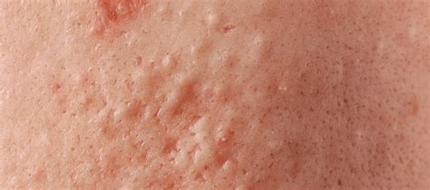 ultimate guide  comedones  face   treatments