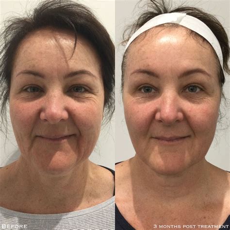 HIFU Face Lifting – Skincare Laser Clinic