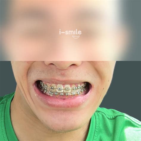braces  smile