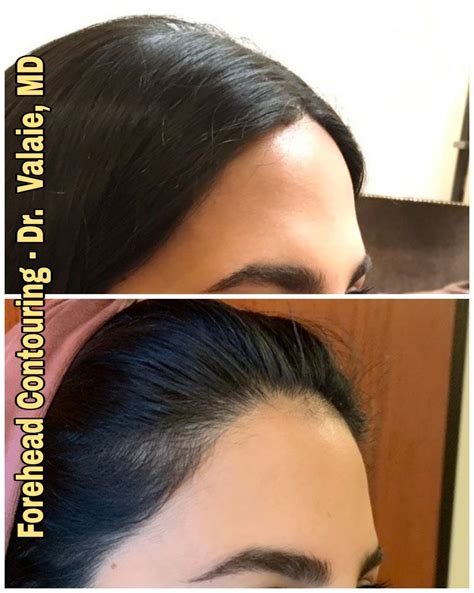 Effortlessly Reduce Your Forehead Size with Expert Contouring Techniques - Hunter Games Magazine