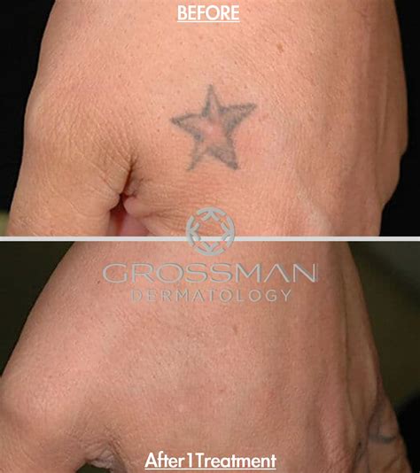 Laser Tattoo Removal Kentucky at Erin Patteson blog
