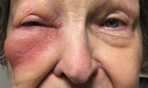 Between the Septal Divide: Managing Preseptal and Orbital Cellulitis