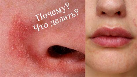 Шелушится кожа на лице у мужчины - покраснение и шелушение после бритья ...