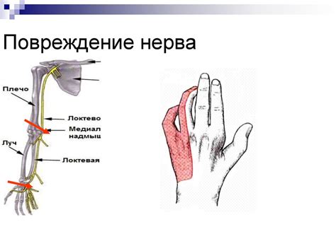 Невропатия лучевого, локтевого и срединного нервов - презентация онлайн